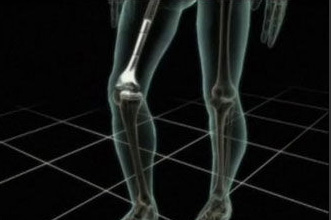 “喷射模铸”有助制作人造骨