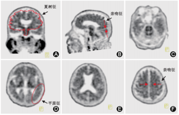 淀粉样蛋白PET显像应用共识发布 助力把握阿尔茨海默病诊疗黄金窗口期