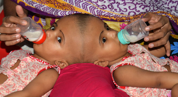 孟加拉国头部连体女婴将准备接受分离手术